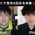 【40代ヒゲ脱毛の効果】サロン雅で6回受けたリアルな変化と写真比較