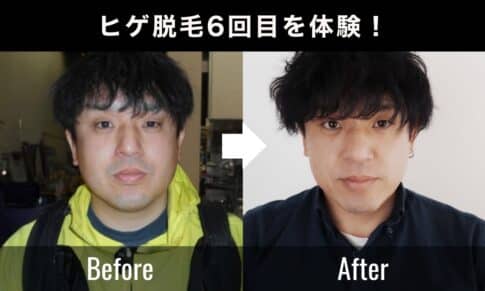 【40代ヒゲ脱毛の効果】サロン雅で6回受けたリアルな変化と写真比較