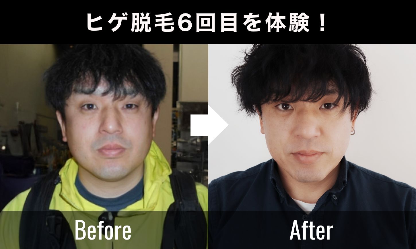 【40代ヒゲ脱毛の効果】サロン雅で6回受けたリアルな変化と写真比較