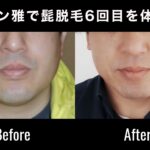 サロン雅で髭脱毛6回目を体験！