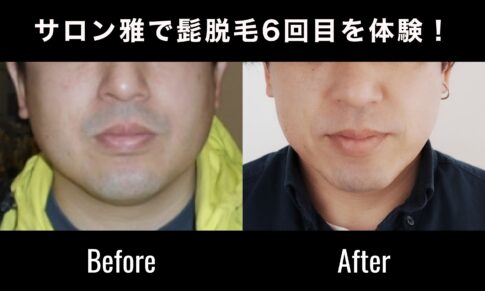 サロン雅で髭脱毛6回目を体験！