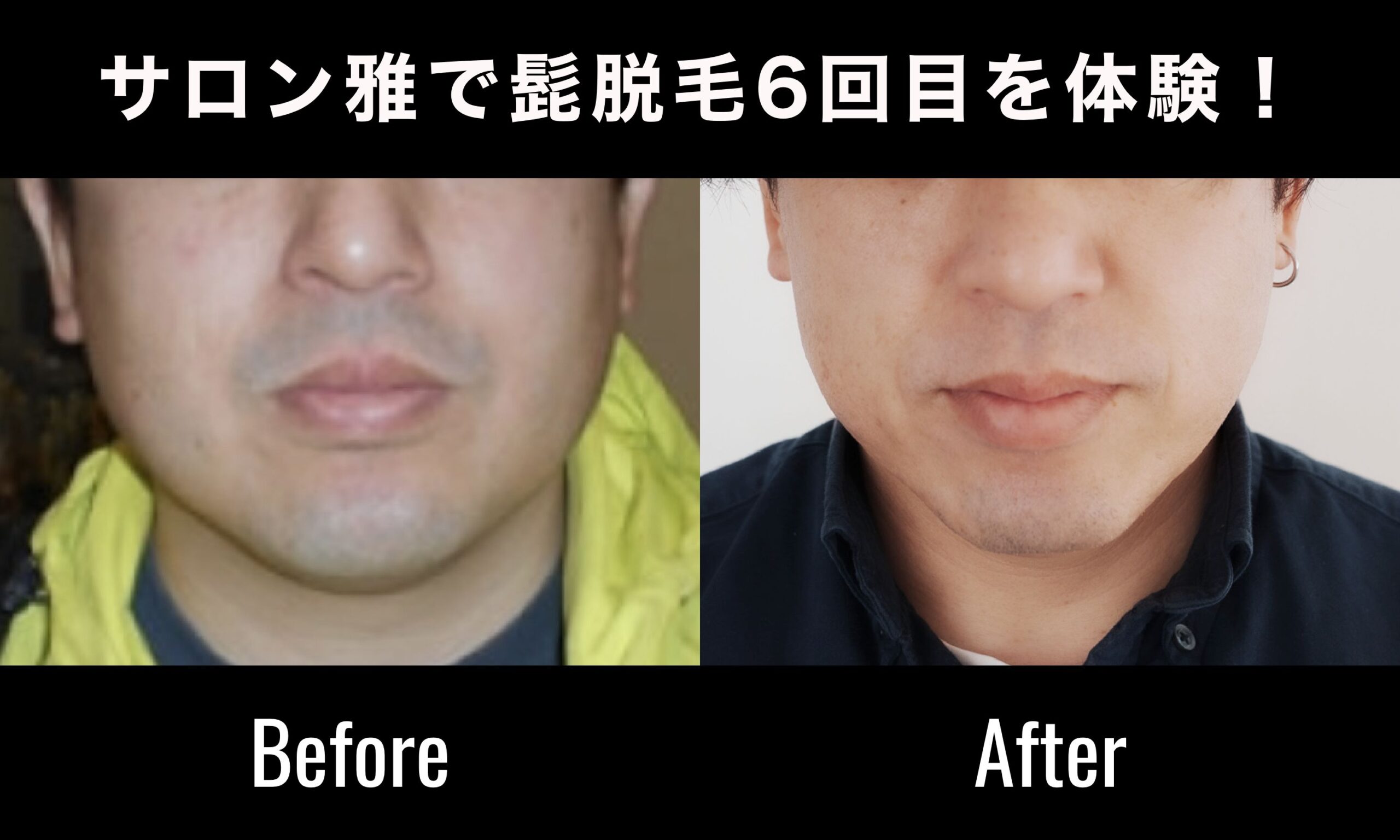 サロン雅で髭脱毛6回目を体験！