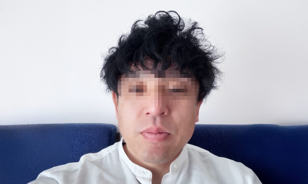 施術前の状態(After):6回目以降の瀬術後の写真です。