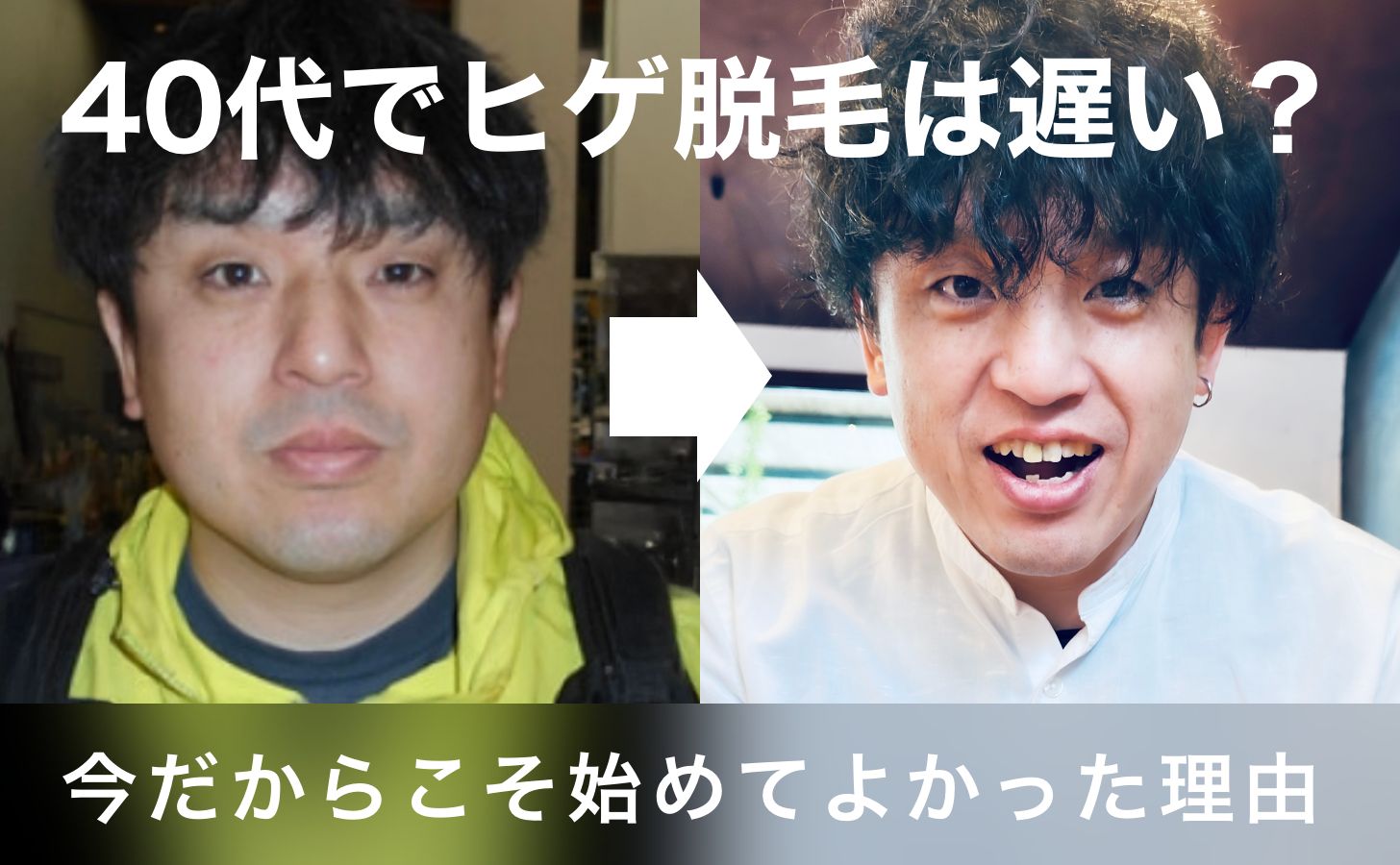 【40代でヒゲ脱毛は遅い？】今だからこそ始めてよかった理由と僕のリアルな声