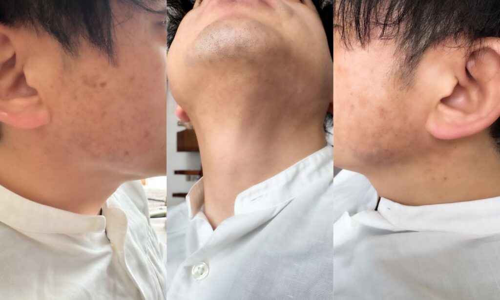 施術前の状態(After):6回目以降の瀬術後の写真です。