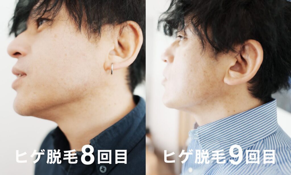ヒゲ脱毛の9回目終了時点のヒゲの状態