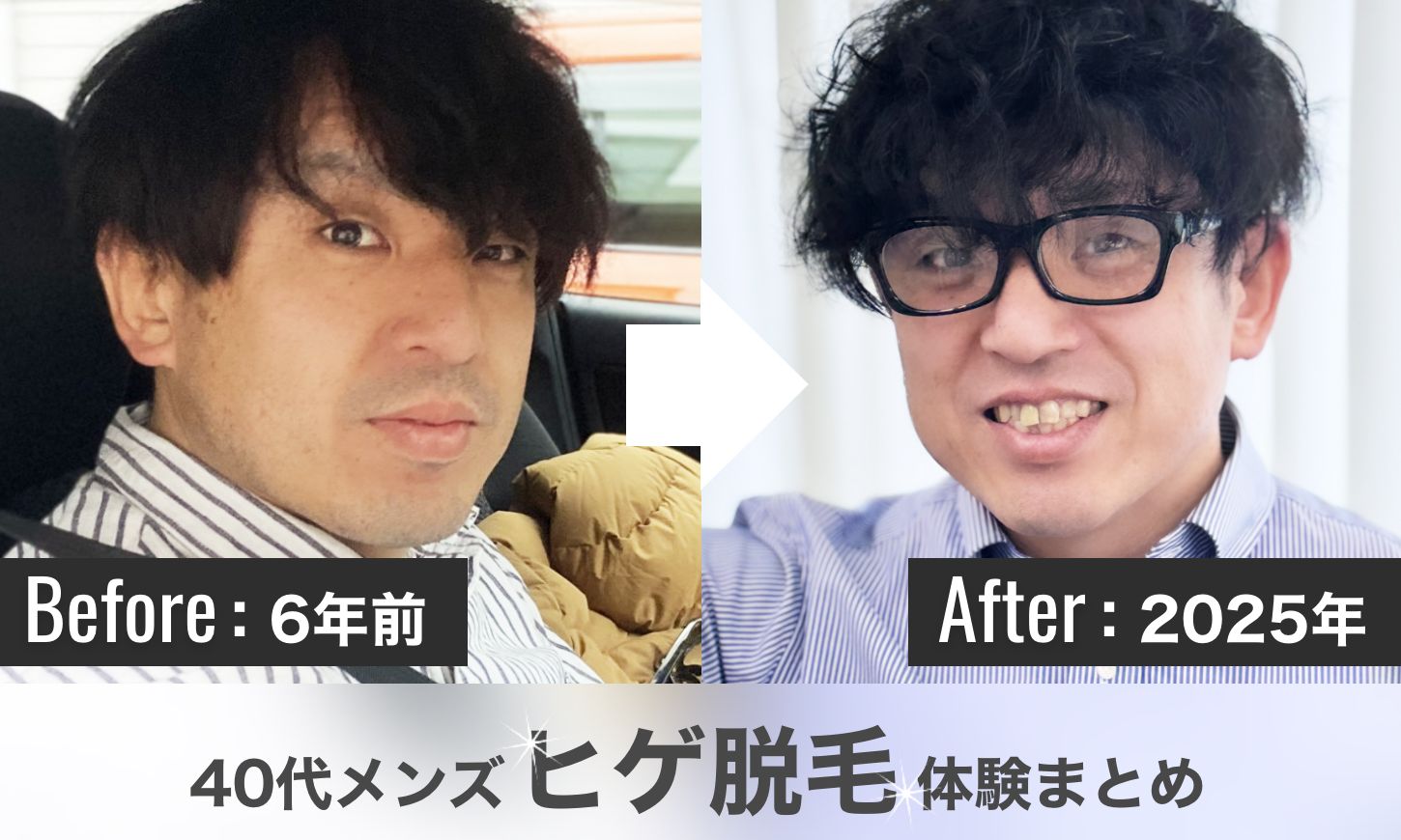 40代ヒゲ脱毛まとめ記事