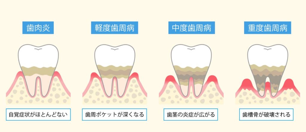 口臭が起きる「3つの要因」：歯周病や磨き残し