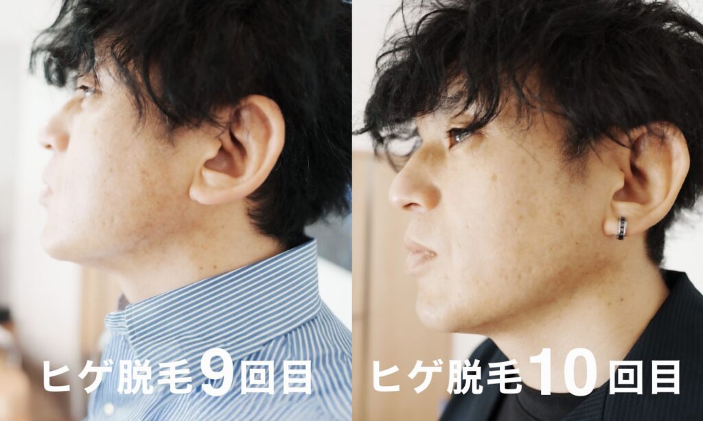 ヒゲ脱毛10回目の施術後の様子