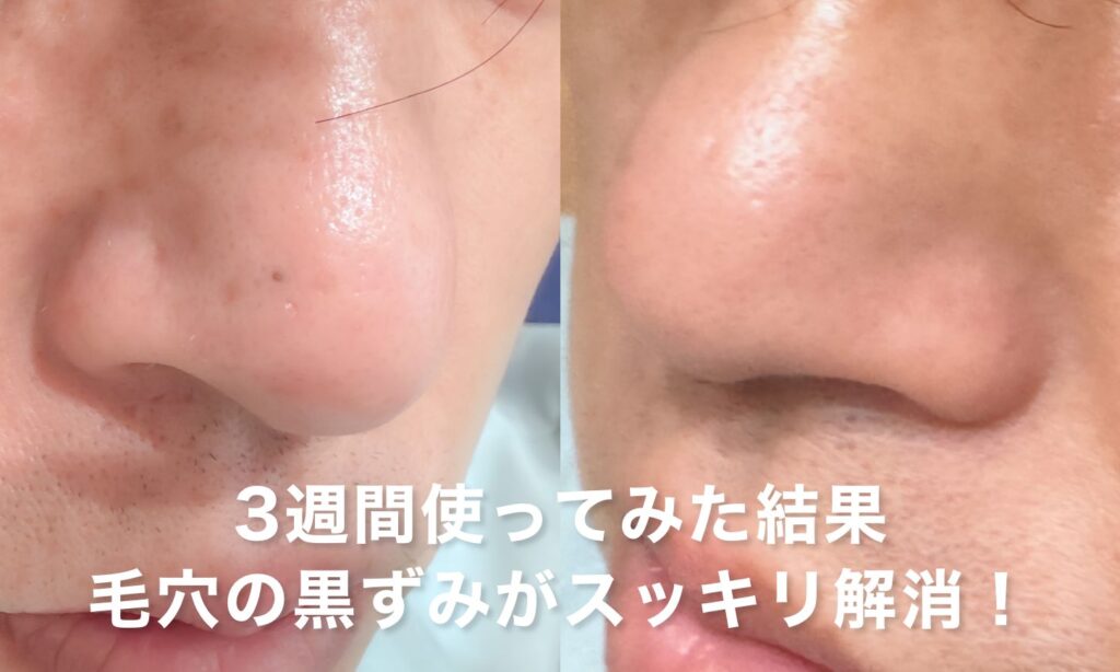 3週間使ってみた結果。毛穴の黒ずみがスッキリ解消！