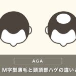 前頭部・M字型薄毛と頭頂部ハゲの違いと治療法