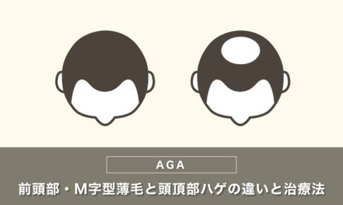 前頭部・M字型薄毛と頭頂部ハゲの違いと治療法