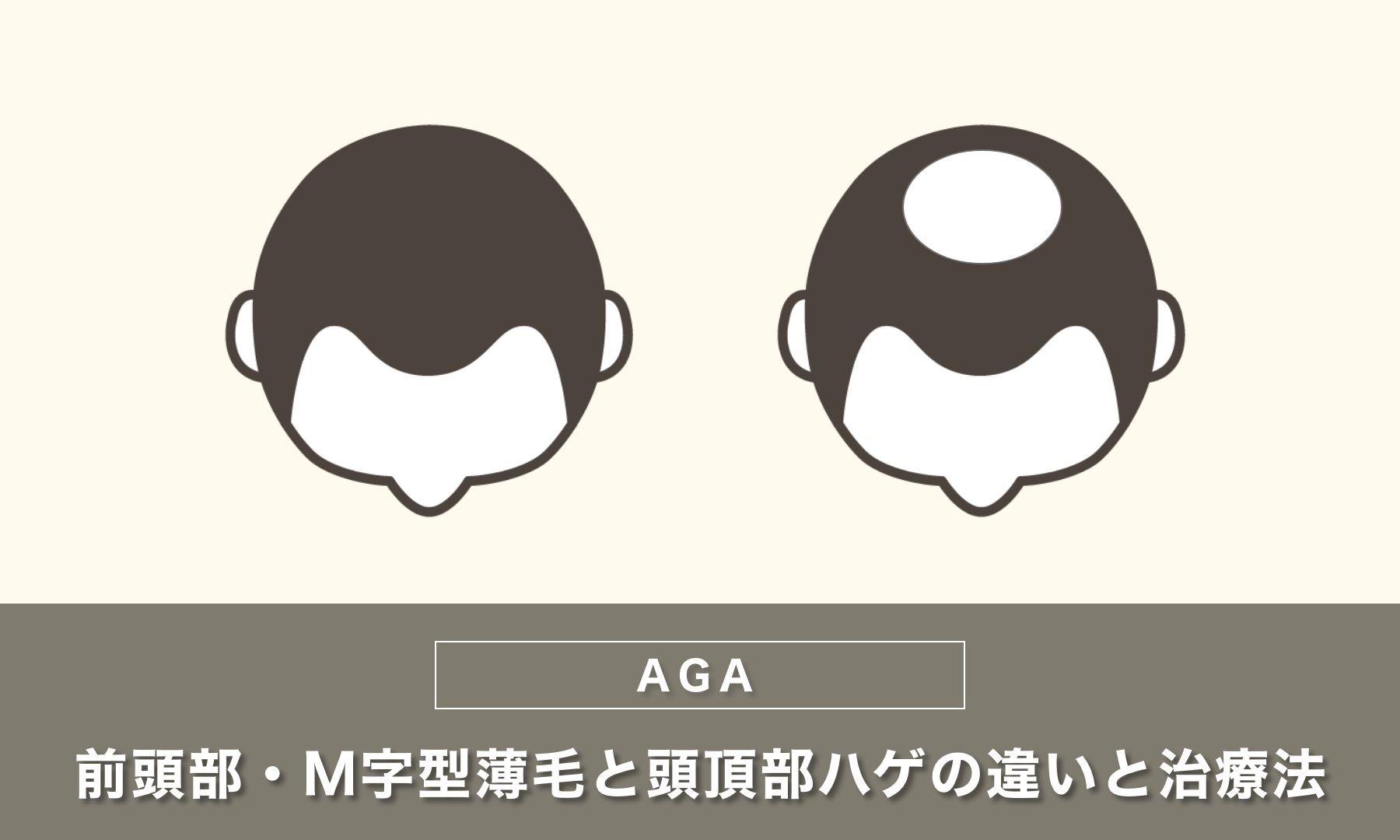 前頭部・M字型薄毛と頭頂部ハゲの違いと治療法