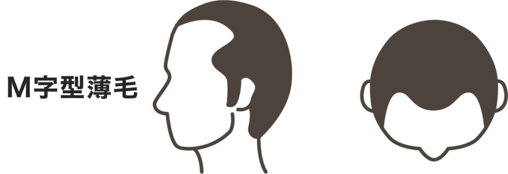 頭頂部ハゲ