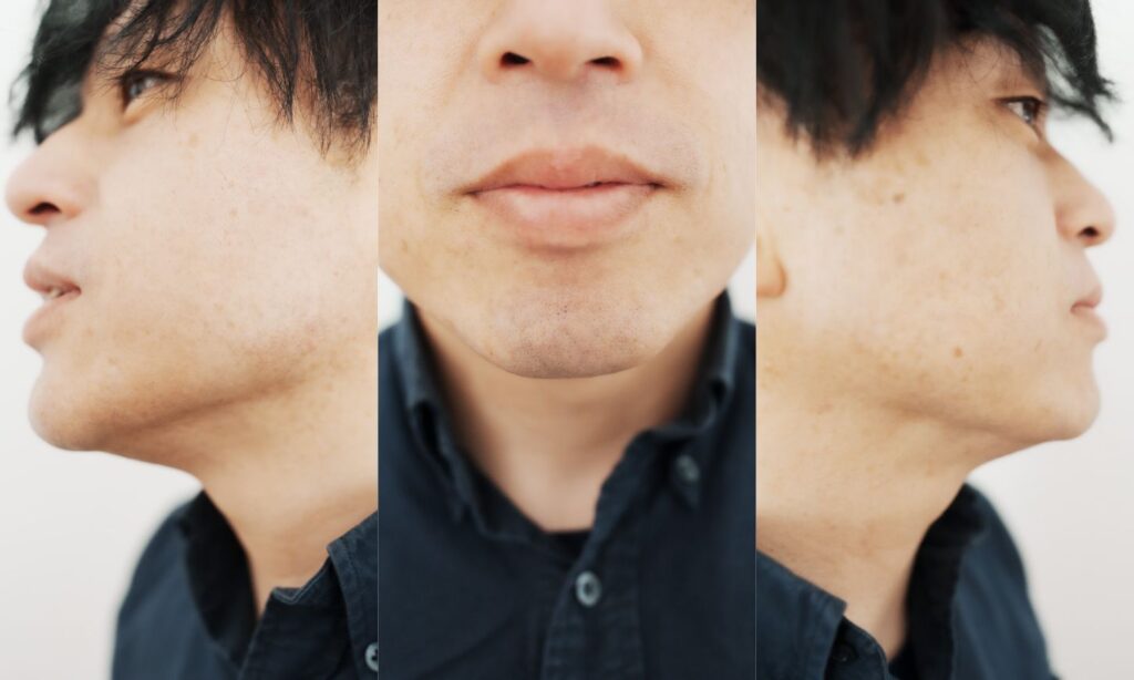 ヒゲ脱毛：8回目の様子