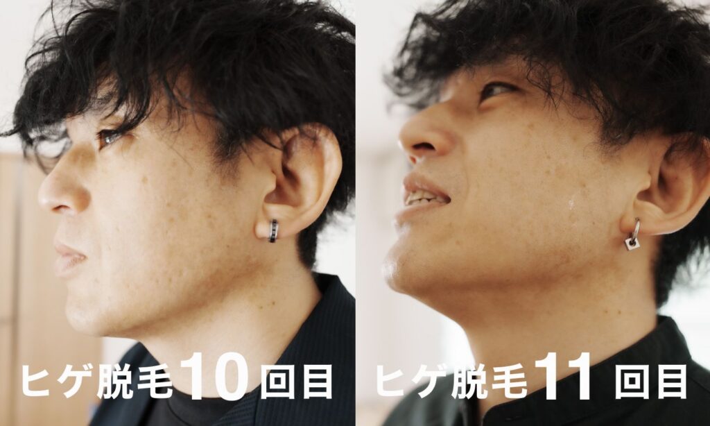 ヒゲ脱毛10回目と11回目の比較