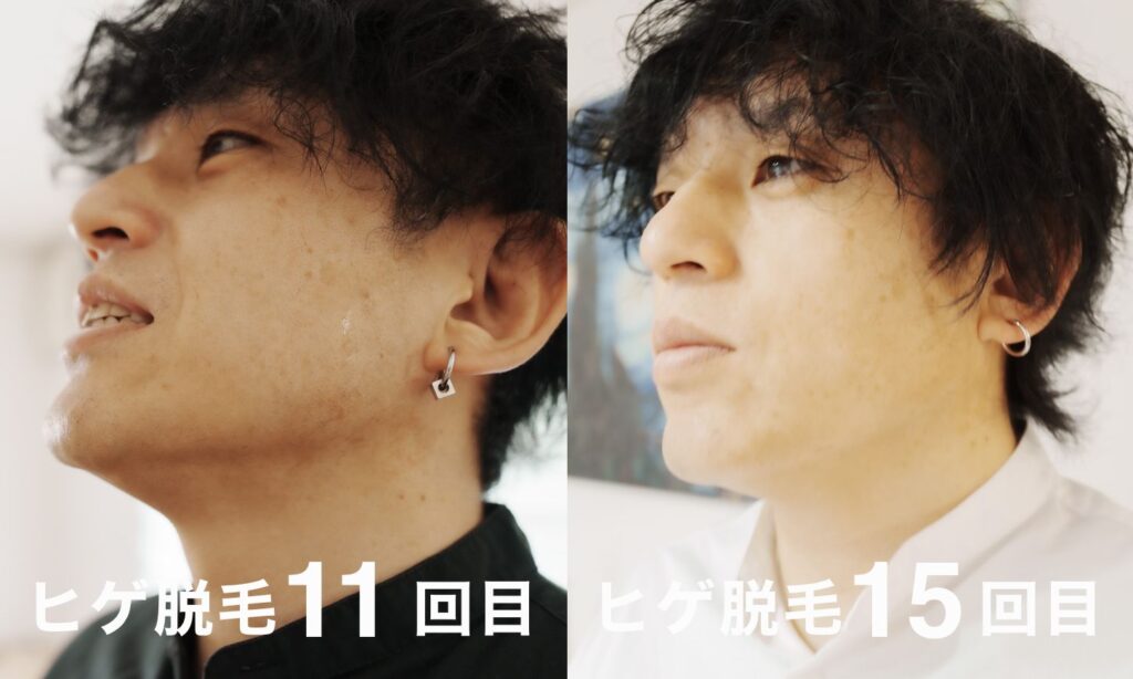 ヒゲ脱毛11回目と15回目の比較
