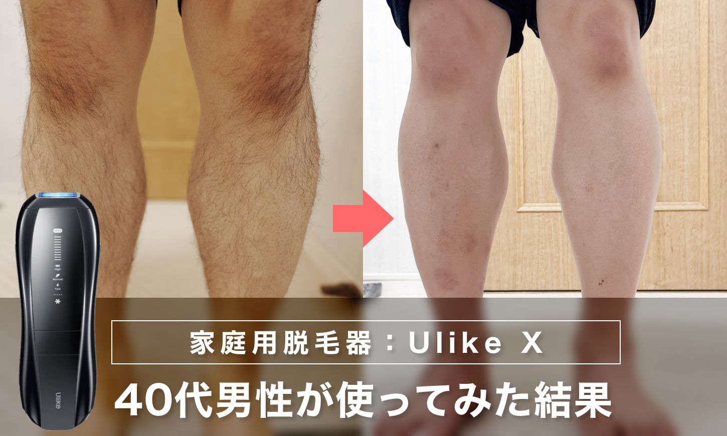 【家庭用脱毛器】Ulike Xを40代男性が使ってみた結果｜太ももと膝下で見えた違い