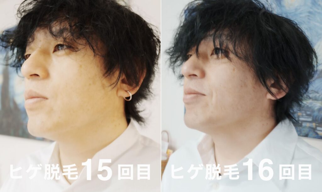 ヒゲ脱毛15回目と16回目の比較写真