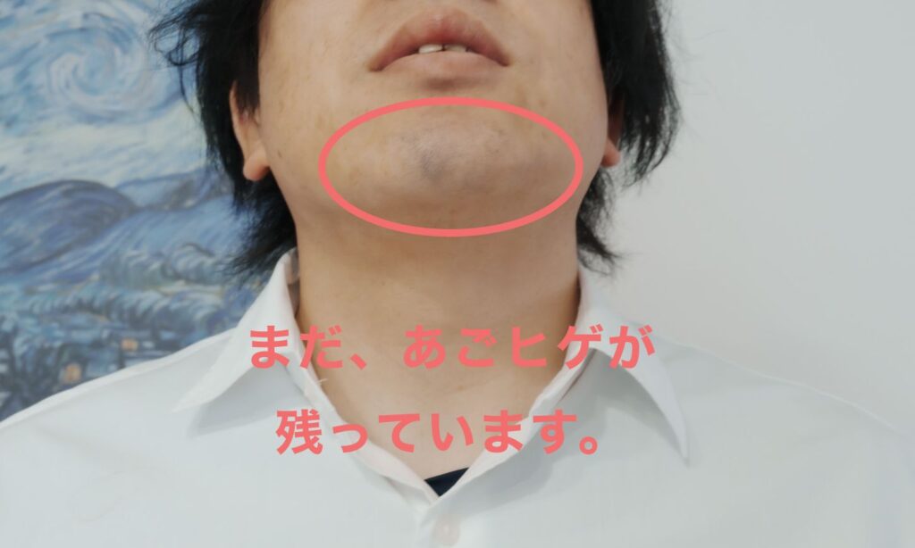 あごヒゲだけが、粘り強い！