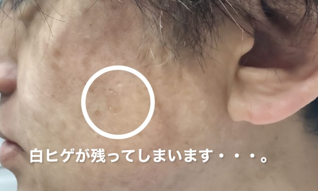 脱毛にはタイムリミットがある：白ヒゲが残ってしまいます・・・。