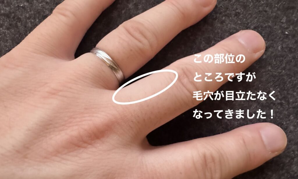 Ulike Xを使って、指毛を脱毛