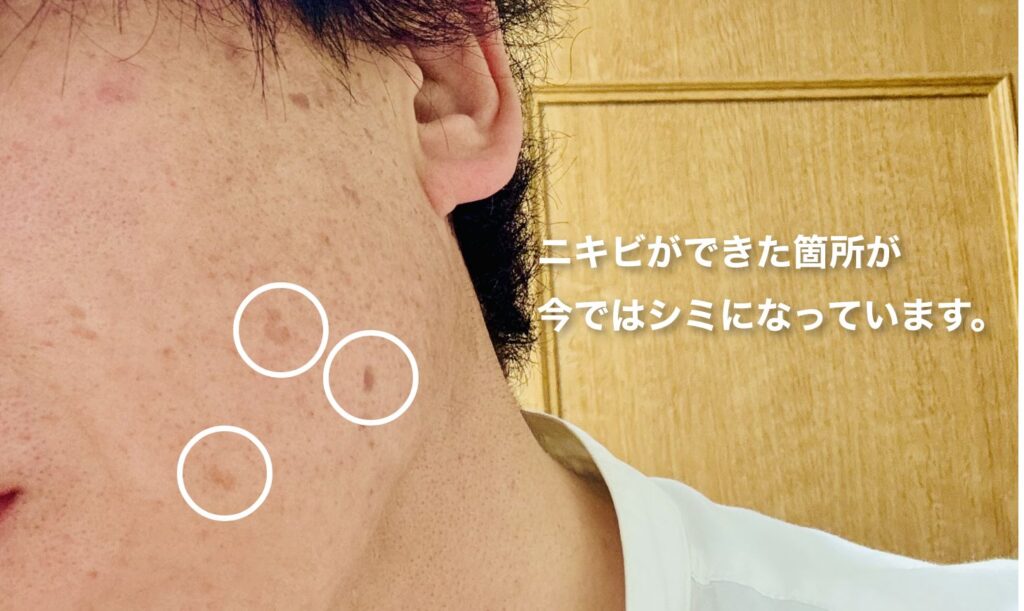 ニキビができた箇所が今ではシミになっています。